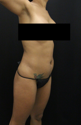 Tummy Tuck: Case 57 - Before