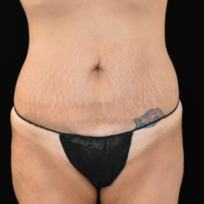 Abdominoplasty Case 8 - Before
