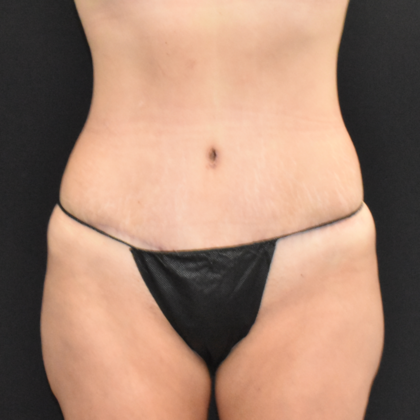 Abdominoplasty Case 8 - After
