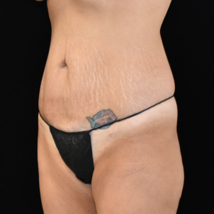 Abdominoplasty: Case 8 - Before