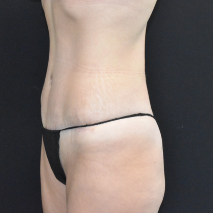Abdominoplasty: Case 8 - After