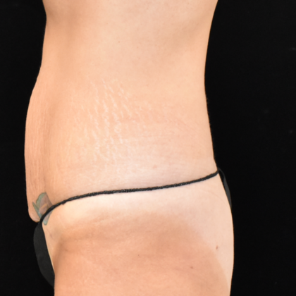Abdominoplasty: Case 8 - Before