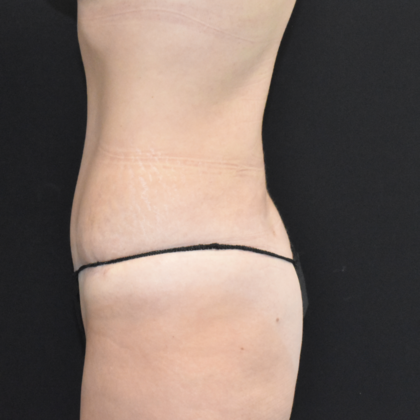 Abdominoplasty: Case 8 - After