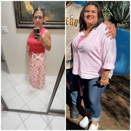 Gastric Sleeve - Click Here to See More! : Edna T - Before & After