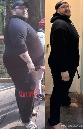 Gastric Sleeve - Click Here to See More! : Piers B - Before & After