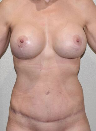 Mommy Makeover Case 291 - After