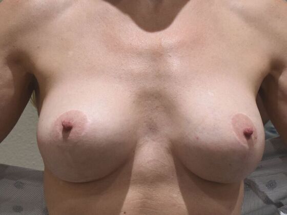 Breast Revision: Case 231 - Before