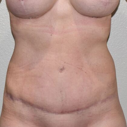 Tummy Tuck (Abdominoplasty): Case 453 - After