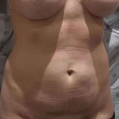Tummy Tuck (Abdominoplasty): Case 453 - Before