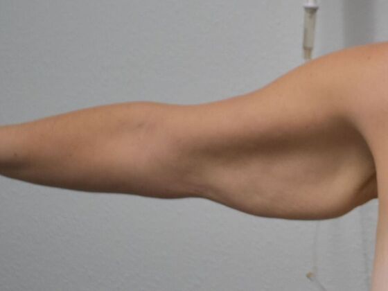 Brachioplasty Case 20 - Before