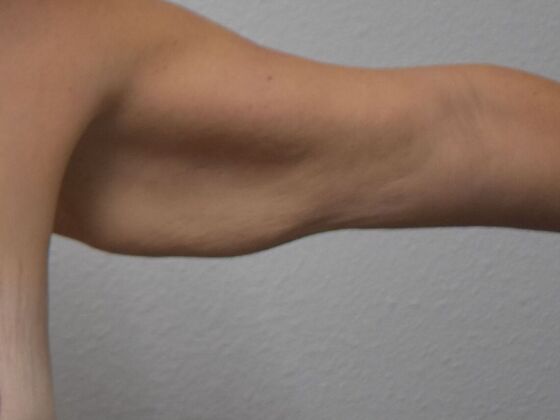 Brachioplasty: Case 20 - Before