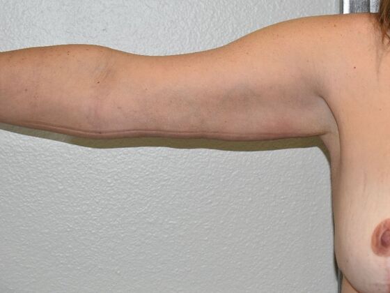 Brachioplasty Case 20 - After