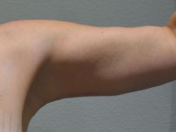 Brachioplasty: Case 20 - After