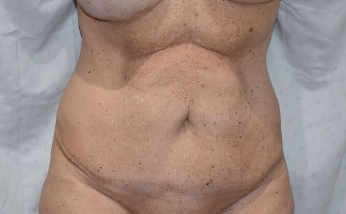 Tummy Tuck (Abdominoplasty): Case 454 - Before