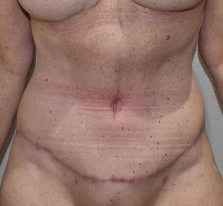 Tummy Tuck (Abdominoplasty): Case 454 - After