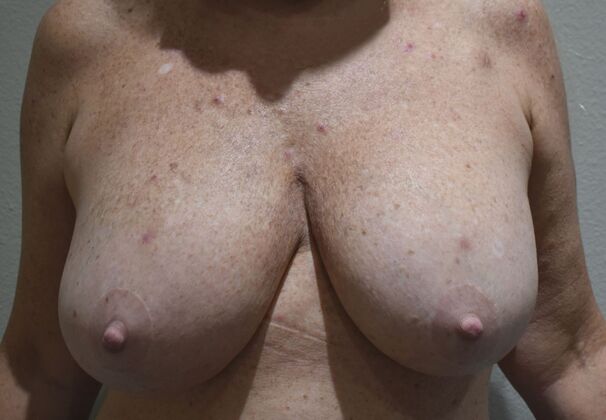 Breast Reconstruction Case 84 - Before