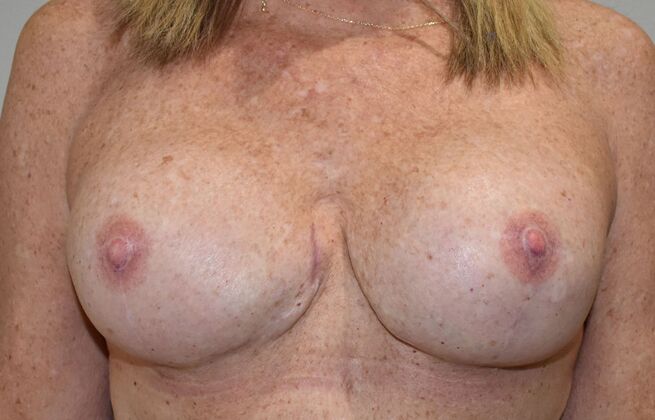 Breast Reconstruction Case 84 - After