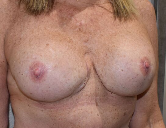Breast Reconstruction: Case 84 - After