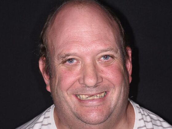 All on 4 (Full Arch Implant Cases) Case 12: Lower All on 4 - Before