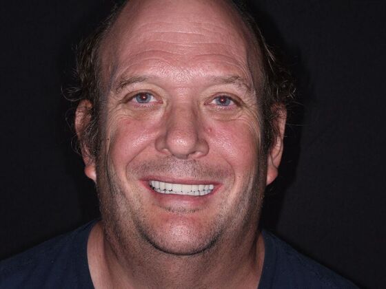 All on 4 (Full Arch Implant Cases) Case 12: Lower All on 4 - After