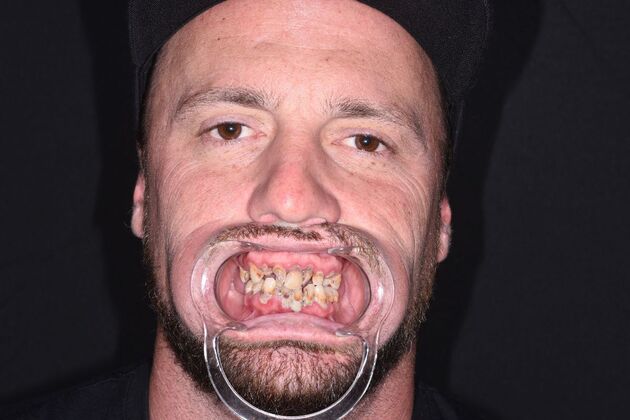 All on 4 (Full Arch Implant Cases) Case 13: Upper and Lower All on 4 - Before