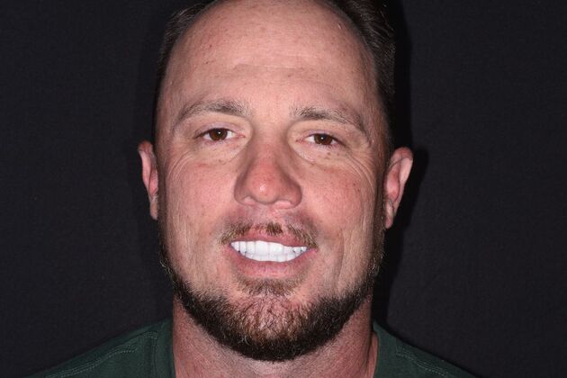 All on 4 (Full Arch Implant Cases) Case 13: Upper and Lower All on 4 - After