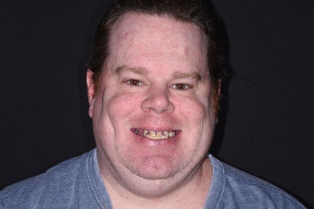 All on 4 (Full Arch Implant Cases) Case 14: Upper and Lower All on 4 - Before