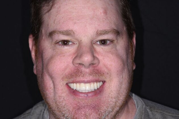 All on 4 (Full Arch Implant Cases) Case 14: Upper and Lower All on 4 - After