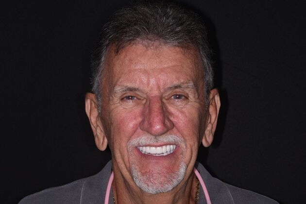 All on 4 (Full Arch Implant Cases) Case 15: Upper and Lower All on 4 - After