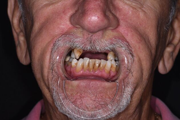 All on 4 (Full Arch Implant Cases) Case 15: Upper and Lower All on 4 - Before