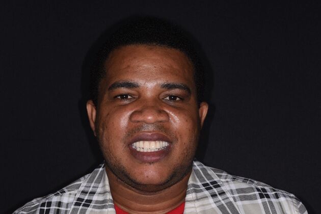 All on 4 (Full Arch Implant Cases): Case 16: Upper Arch Only - After