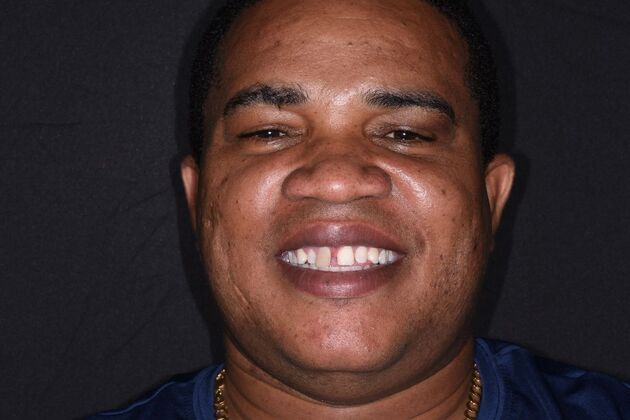 All on 4 (Full Arch Implant Cases): Case 16: Upper Arch Only - Before