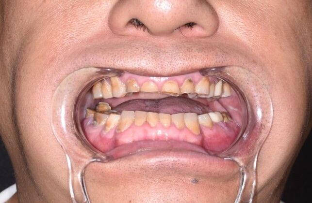 All on 4 (Full Arch Implant Cases) Case 17: Upper and Lower All on 4 - Before