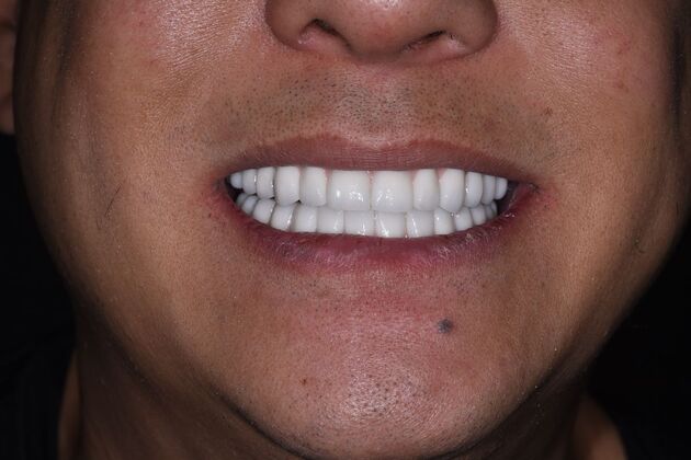 All on 4 (Full Arch Implant Cases) Case 17: Upper and Lower All on 4 - After