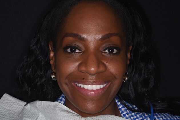 All on 4 (Full Arch Implant Cases) Case 18: Upper and Lower All on 4 - After