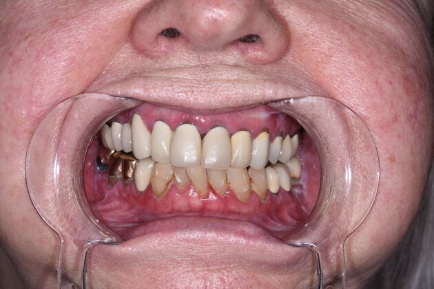 All on 4 (Full Arch Implant Cases) Case 19: Upper and Lower All on 4 - Before