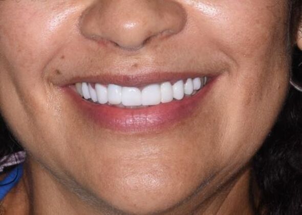 Cosmetic Dentistry: Case 5:  Hollywood Smile Makeover - Veneers and Crowns - After