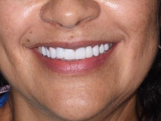 Cosmetic Dentistry Case 5:  Hollywood Smile Makeover - Veneers & Crowns - After