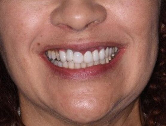 Cosmetic Dentistry: Case 5:  Hollywood Smile Makeover - Veneers and Crowns - Before