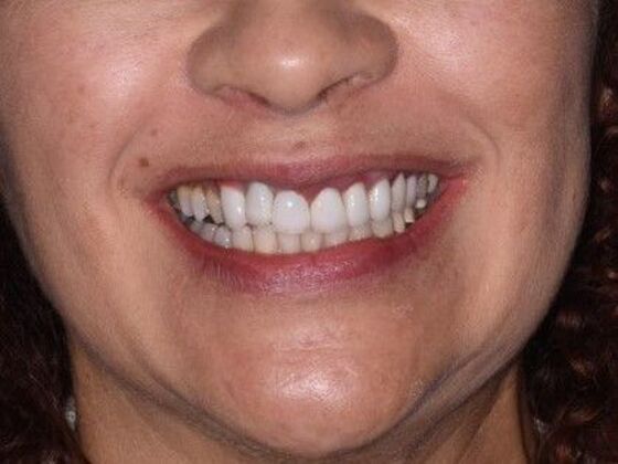 Cosmetic Dentistry Case 5:  Hollywood Smile Makeover - Veneers & Crowns - Before