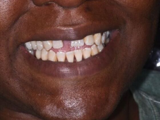 Cosmetic Dentistry: Case 6: Smile Makeover - Crowns - Before