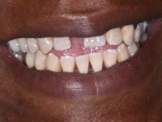 Cosmetic Dentistry Case 6: Smile Makeover - Crowns - Before