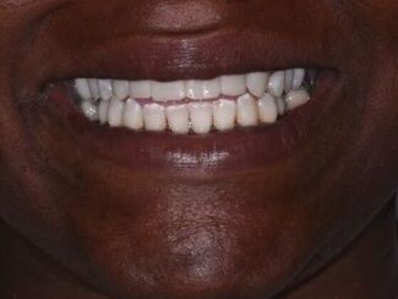 Cosmetic Dentistry: Case 6: Smile Makeover - Crowns - After