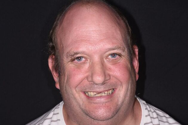 Cosmetic Dentistry: Case 7: Cosmetic Crowns and Upper Implants - Before