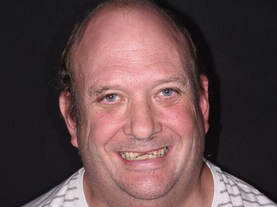 Cosmetic Dentistry Case 7: Cosmetic Crowns & Upper Implants  - Before