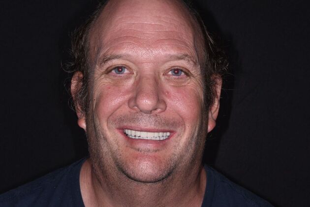 Cosmetic Dentistry: Case 7: Cosmetic Crowns and Upper Implants - After