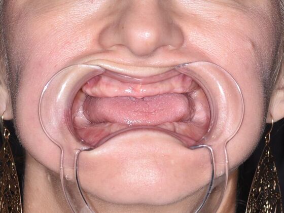 All on 4 (Full Arch Implant Cases) Case 20: Upper and Lower All on 4 - Before