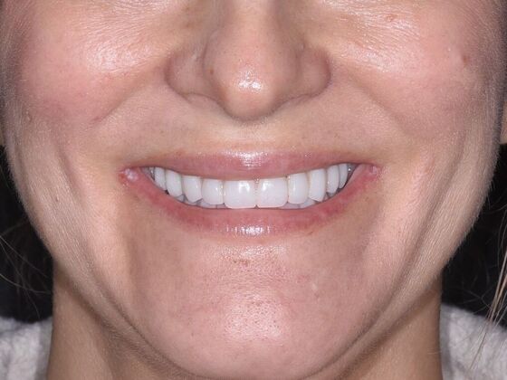 All on 4 (Full Arch Implant Cases) Case 20: Upper and Lower All on 4 - After