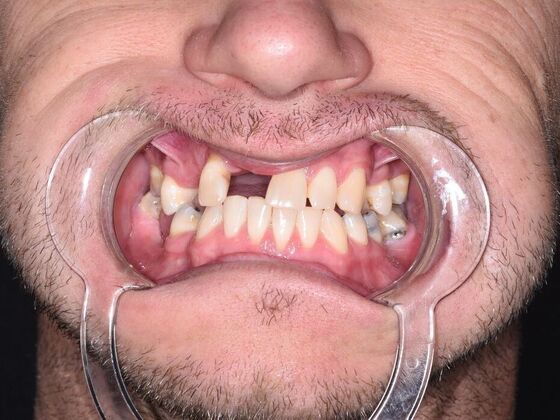 All on 4 (Full Arch Implant Cases) Case 21: Upper All on 4 - Before