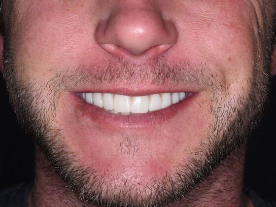 All on 4 (Full Arch Implant Cases) Case 21: Upper All on 4 - After